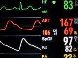 EKG